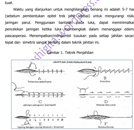 Gambar 1. Teknik Penjahitan 