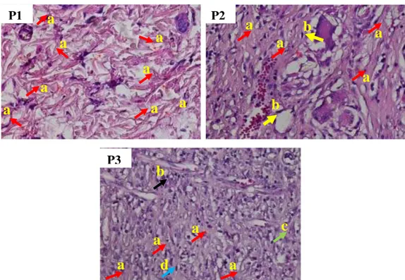 Gambar  4.2.  Gambaran  histopatologi  perlakuan  P1  memiliki  skor  kepadatan  kolagen  yaitu  3,  tampak  adanya  serabut  kolagen  yang  dominan  (a)