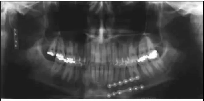Gambar 8. Gambaran fraktur subkondilar praoperasi dari pandangan lateral.(Cho-Lee, Endoscopically-assist transoral approachfor the treatment of subconylar fraktures of the mandible, Med Oral Patol Oral Cir Bucal