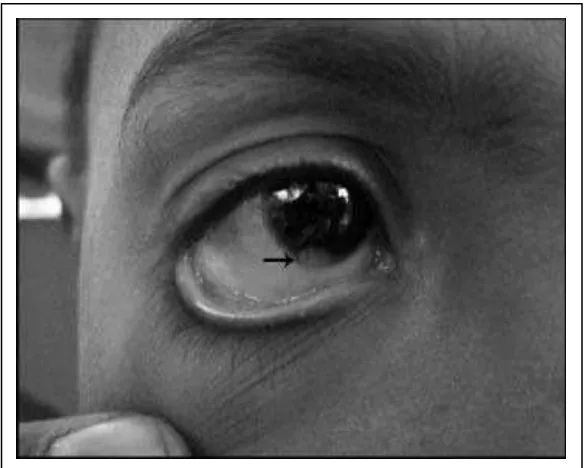 Gambar 4. Lipodermoid di bawah pupil mata kanan (panah).6 