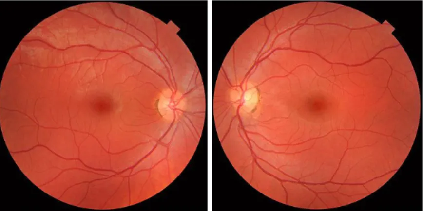 Figure 1.1: Fundus photographs of the normal both right (left image) and left eye (right image)