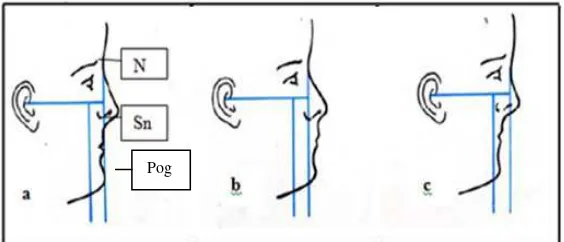 Gambar 9. Analisis profil wajah menurut Schwarz. (a) Lurus   (Average).  (b) Cembung (Anteface)