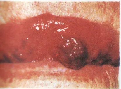 Gambar 3 : Hemangioma kavernosa berbentuk kubah pada ventral lidah                           27 