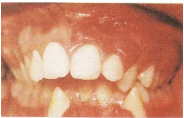 Gambar 9 :   Hemangioma intra oral yang unilateral pada                                       pasien dengan sindroma 
