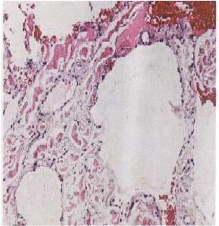 Gambar 10 :   Hemangioma bibir, terlihat peningkatan jumlah pembuluh darah                                                            venous yang terisi blood clot (tanda panah) di bawah mukosa  
