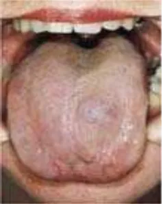 Gambar 12 : Malformasi vaskular pada lidah 32