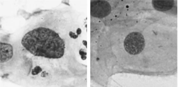 Gambar 2.1 Perbandingan antara inti sel yang terserang kanker (kiri) dan inti sel  normal (kanan) (Malm dkk., 2013)