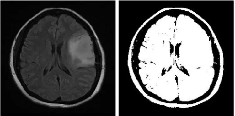 Gambar 4.1 Citra MRI (a) dan Citra Hasil Thresholding (b) untuk Ax T2 Flair  IM21