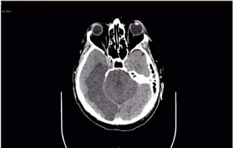 Figure 1. A non-contrast CT scan showing extensive ischemic lesions in the brainstem, as  well as the entire area supplied by the right posterior cerebral artery