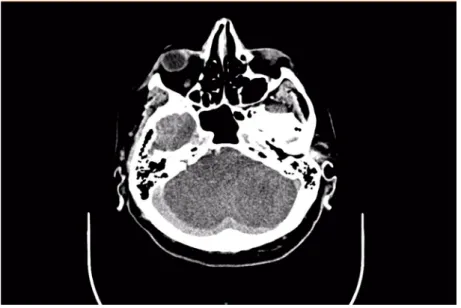 Figure 3. Same CT scan,  also showing ischemia of  complete cerebellum. 