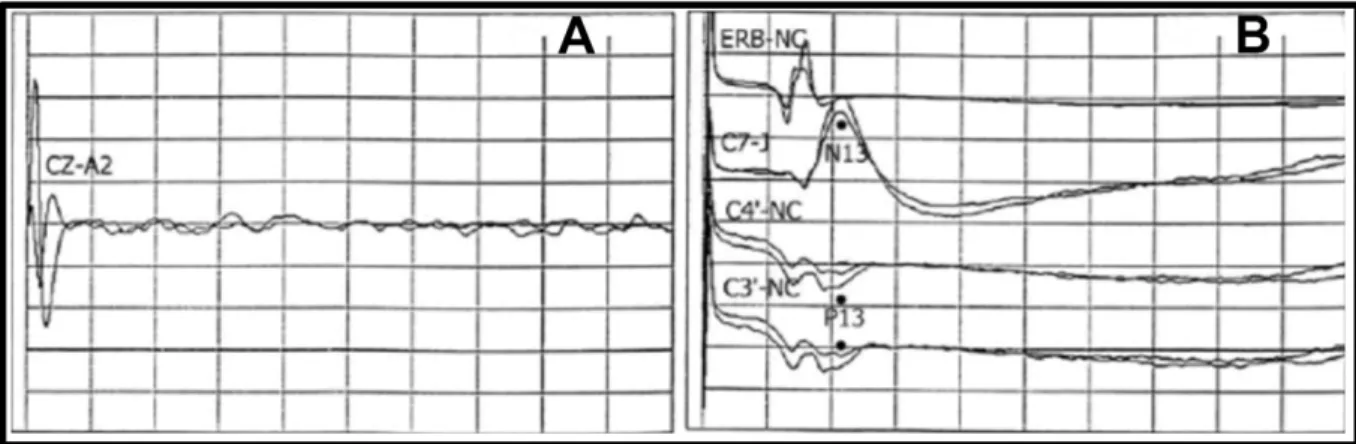 Fig. 4. The combined recordings of auditory brain stem responses (ABRs) (A) and  somatosensory evoked potentials (SEPs) (B), after the clinical onset of brain death, shows  absent potential response confirming the death of the brain stem (Facco et al
