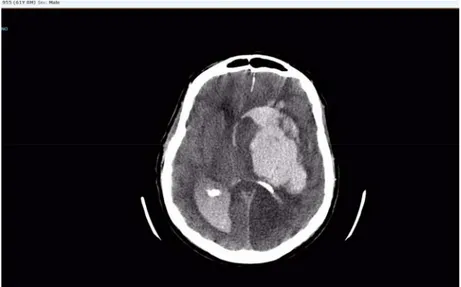 Figure 5. Non-contrast CT scan showing massive intracerebral and intraventricular  haemorrhagia, also causing acute subfalcine herniation