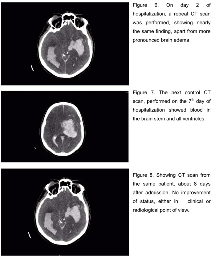 Figure 6. On day 2 of  hospitalization, a repeat CT scan  was performed, showing nearly  the same finding, apart from more  pronounced brain edema