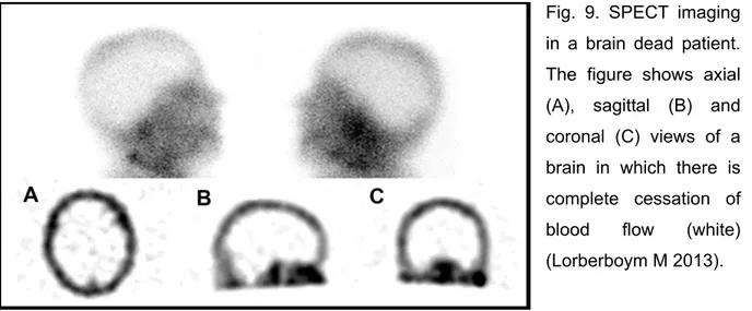 Fig. 9. SPECT imaging  in a brain dead patient.  The figure shows axial  (A), sagittal (B) and  coronal (C) views of a  brain in which there is  complete cessation of  blood flow (white)  (Lorberboym M 2013)