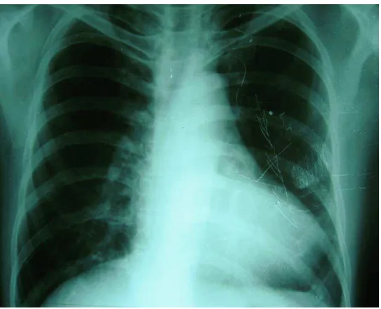 Gambar 1. EKG pada tanggal 20 Desember 2010 