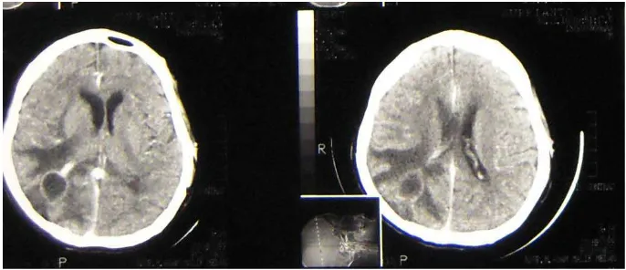Gambar 5. Head CT Scan Contrast 31 Desember 2010 