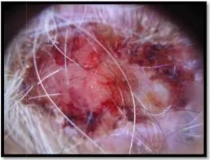 Gambar 1. Karsarsinoma sel basal pada dahi kanan
