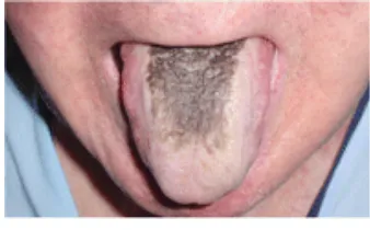 Gambar 2. Hairy Tongue21 
