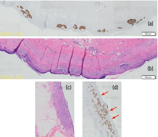 Gambar 1: Perbandingan hasil pewarnaan dengan Hematoxylin &amp; Eosin (HE) (a&amp; c) dan imunohistokimia BerEP4 (b&amp; d) pada KSB   dengan multipel mikrolesi yang tersebar sepanjang lapisan epidermis yang sulit didiagnosis dengan pewarnaan rutin HE.