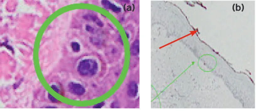 Gambar 2: Perbandingan hasil pewarnaan dengan Hematoxylin dan Eosin (HE) dan imunohistokimia BerEP4 (b)   pada lesi KSB yang hanya baru 1 sel dan sulit didiagnosis dengan pewarnaan rutin HE.