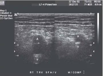 Gambar 4. USG Duplex dari vena normal. Vena sepenuhnya dapat 