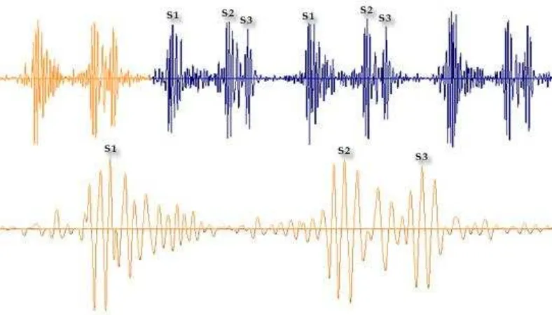 Gambar 2.4. Contoh ragam gelombang suara jantung (Stethographics, 2007) 