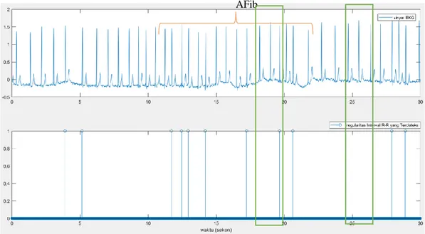 Gambar 8 (Atas) Sinyal EKG dari Penderita Fibrilasi Atrium (FA), dan  (bawah) Iregularitas Interval R-R yang dideteksi oleh Sistem untuk r=0,2    Performa  sistem  ditentukan  berdasarkan  banyaknya  TP  dan  FN