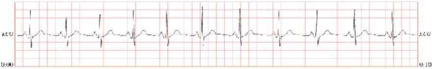 Gambar 4 (d) Contoh grafik melalui fitur Plot Waveform pada PhysioBank ATM 