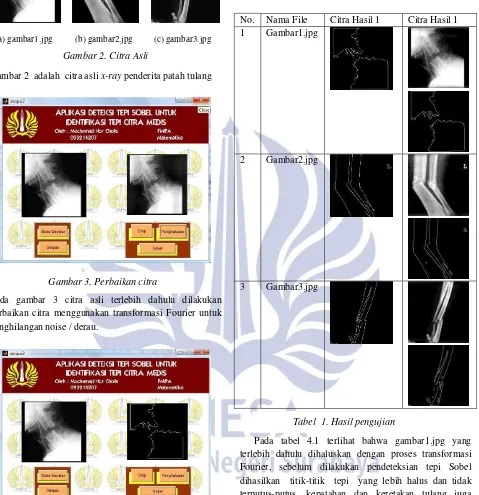 Gambar 2  adalah  citra asli x-ray penderita patah tulang 