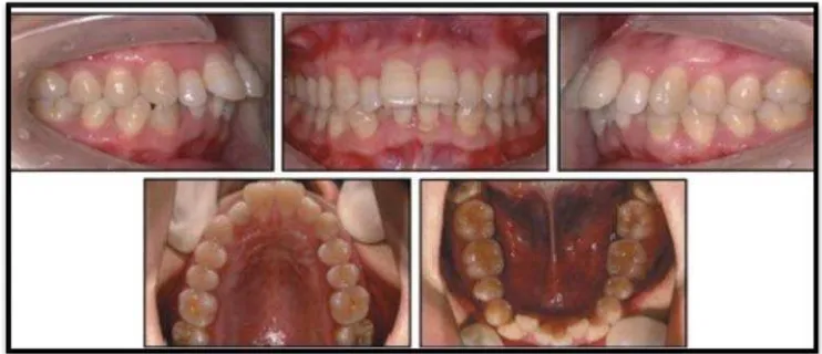 Gambar 4. Asimetri dental pada pasien maloklusi Klas II15 