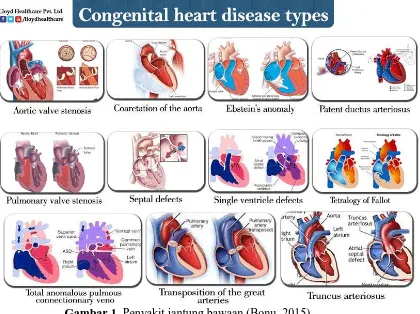 Gambar 1. Penyakit jantung bawaan (Bonu, 2015) 