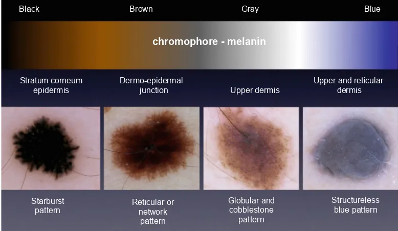 Gambar 2.10. Diagnosis dermoskopi nevi melanositik bergantung pada warna dan pola.Yang paling terpenting kromofor pada nevi melanositik adalah melanin dalamuntuk hingga coklat, sedangkan nevi dengan keterlibatan dermis yang dominan seringmelanosit atau ker