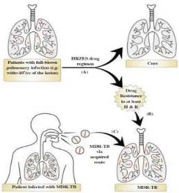 Gambar 3.  Mekanisme terjadinya MDR TB (sumber: Sujay, 2015) 