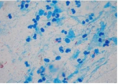 Gambar. 1 Bakteri Mycobacterium tuberculosis pada pengecatan Ziehl Neelsen 