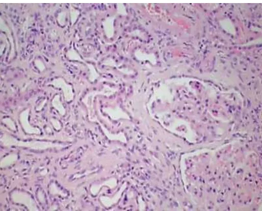 Gambar 8. Gambaran histopatologik yang menunjukkan degenerasi tubulus dan glomerolus