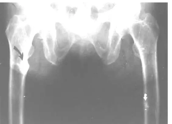 Gambar 9. Gambaran sinar x dari tulang pinggul yang mengalami osteoporosis