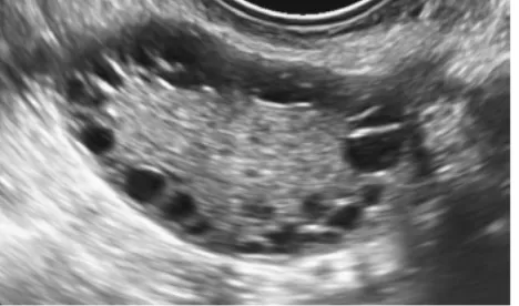 Gambar 2.3. Gambaran Ovarium Polikistik pada ultrasonografi.19 