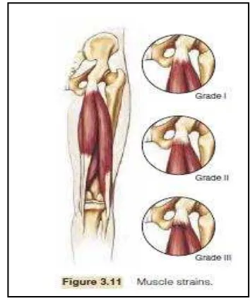Gambar 4. Tingkatan Cedera  Strains Muscle (Robert S. Gotlin 2008: 46) 