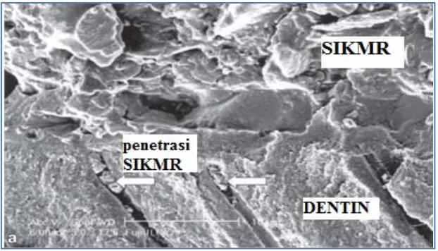 Gambar 2.5. Gambar SEM Permukaan SIKMR dengan Dentin, Penetrasi SIKMR ke dalam Tubulus Dentin (Preenan, 2004) 