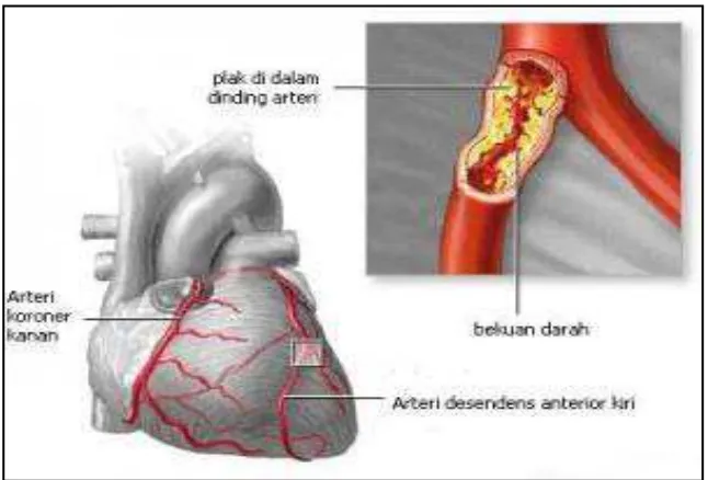 Gambar 6. Plak pada dinding arteri koroner yang menyebabkan Arterosklerosis 