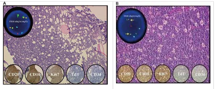 Gambar 2. Morfologi dan pulasan imunohistokimia spesifik pada BL di sum-sum tulang (A) dan kelenjar getah bening (B)