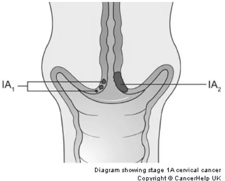 Gambar 2.3.    IAi  menunjukkan ukuran sel kanker ≤ dari 3 mm dalam dan ≤ dari 