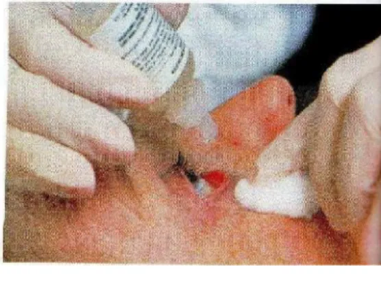 Gambar : Cara Meneteskan Obat Mata (Sumber:Liley,Harrington, Snyder,2007)