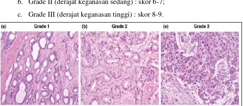Gambar 2.2. Profil Grade Histopatologis I, II, dan III Kanker Payudara  