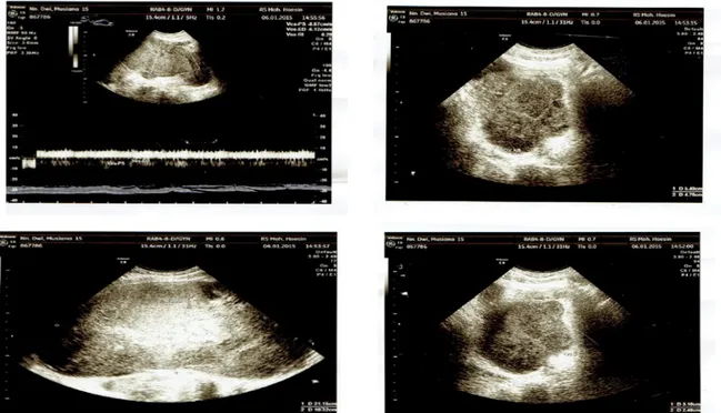 Gambar 1. Ultrasonogr afi Obgin  intralumen  (-),  Adnexa  Parametrium  kanan 