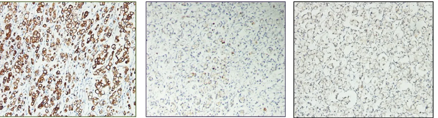 Gambar 3. Mikroskopis Tumor Krukenberg 