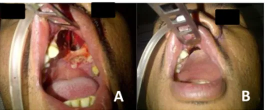 Gambar  4.  A.  Defek  bekas  operasi  terdapat  krusta  kecoklatan. B. Saat obturator terpasang 