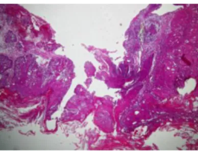 Gambar 5. Tomografi komputer sebelum radioterapi  Pasien  didiagnosis  Squamous  cell  carsinoma glotis keratized well differianted stadium IB  (T1bN0M0)  dan  direncanakan  untuk  dilakukan  radioterapi defenitif