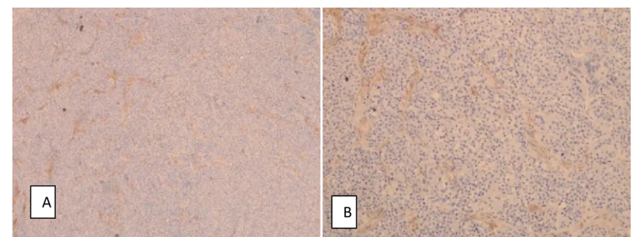 Gambar 17. Immunohistokimia S100 protein tercat positif pada sel-sel tumor (A. pembesaran 100x; B