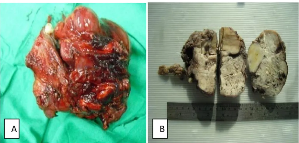 Gambar 2. A. Foto gross sebelum fiksasi; B. Foto gross sesudah fiksasi  dalam cut section Secara  mikroskopis,  tumor  terdiri  atas